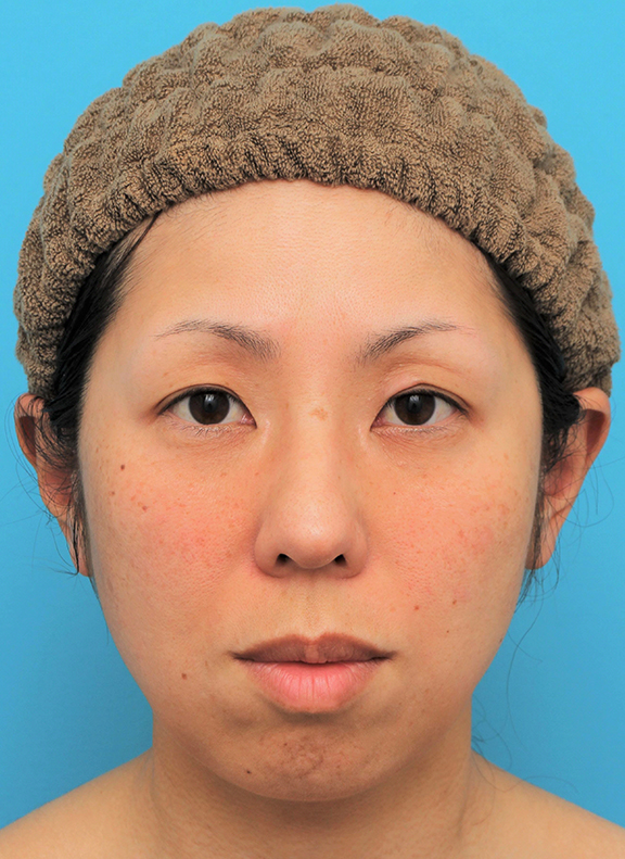 ミディアムフェイスリフト,ミディアムフェイスリフトの症例 頬～フェイスラインのたるみが目立つ40代女性,After（6ヶ月後）,ba_mediumlift015_a01.jpg