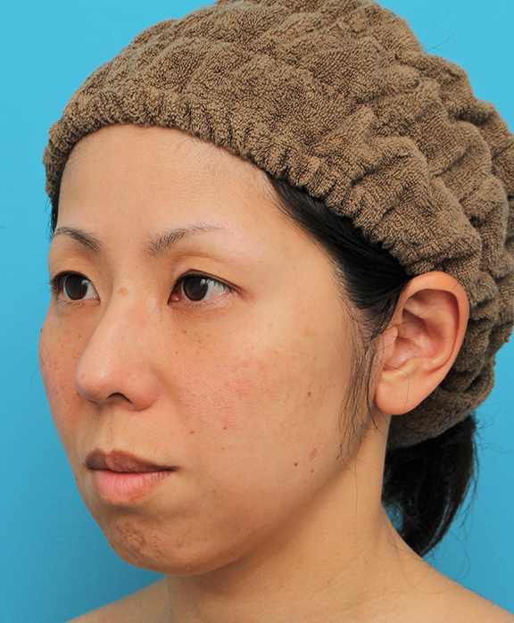 ミディアムフェイスリフト,ミディアムフェイスリフトの症例 頬～フェイスラインのたるみが目立つ40代女性,After（6ヶ月後）,ba_mediumlift015_b02.jpg