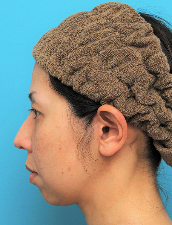 症例写真,ミディアムフェイスリフトの症例 頬～フェイスラインのたるみが目立つ40代女性,After（6ヶ月後）,ba_mediumlift015_b03.jpg