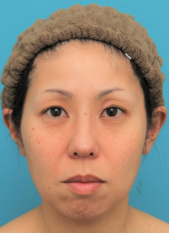 ミディアムフェイスリフト,ミディアムフェイスリフトの症例 頬～フェイスラインのたるみが目立つ40代女性,Before,ba_mediumlift015_b01.jpg