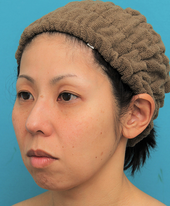 ミディアムフェイスリフト,ミディアムフェイスリフトの症例 頬～フェイスラインのたるみが目立つ40代女性,Before,ba_mediumlift015_b02.jpg
