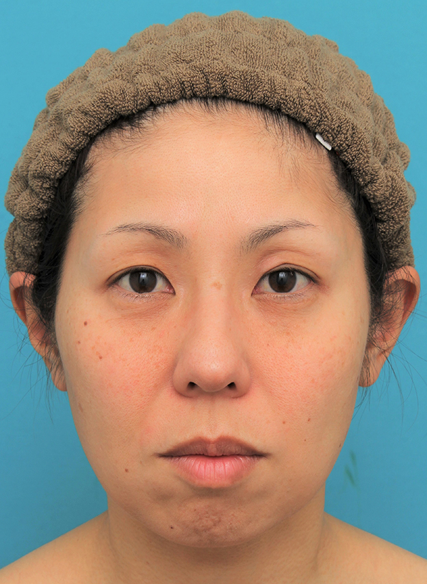 ミディアムフェイスリフト,ミディアムフェイスリフトの症例 頬～フェイスラインのたるみが目立つ40代女性,手術前,mainpic_mediumlift015a.jpg