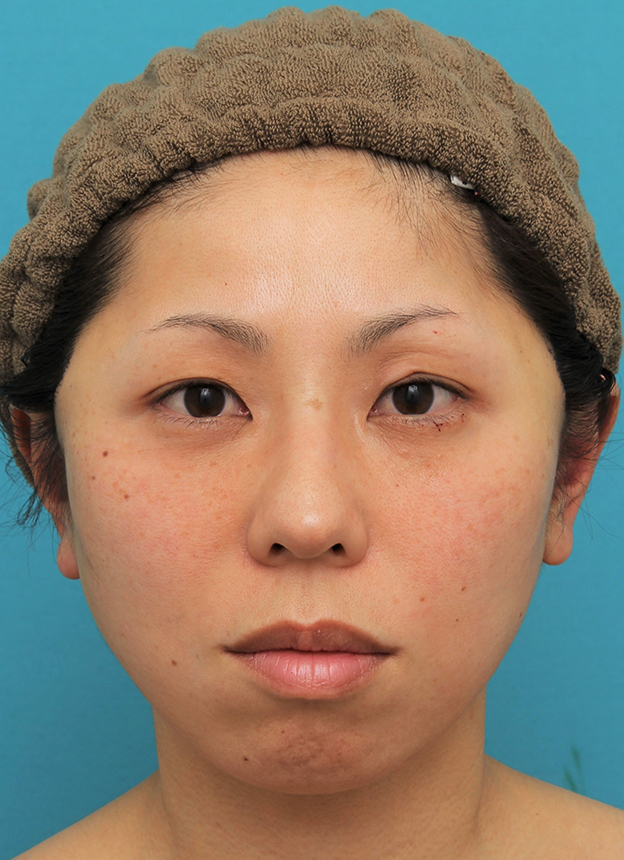 ミディアムフェイスリフト,ミディアムフェイスリフトの症例 頬～フェイスラインのたるみが目立つ40代女性,手術直後,mainpic_mediumlift015b.jpg