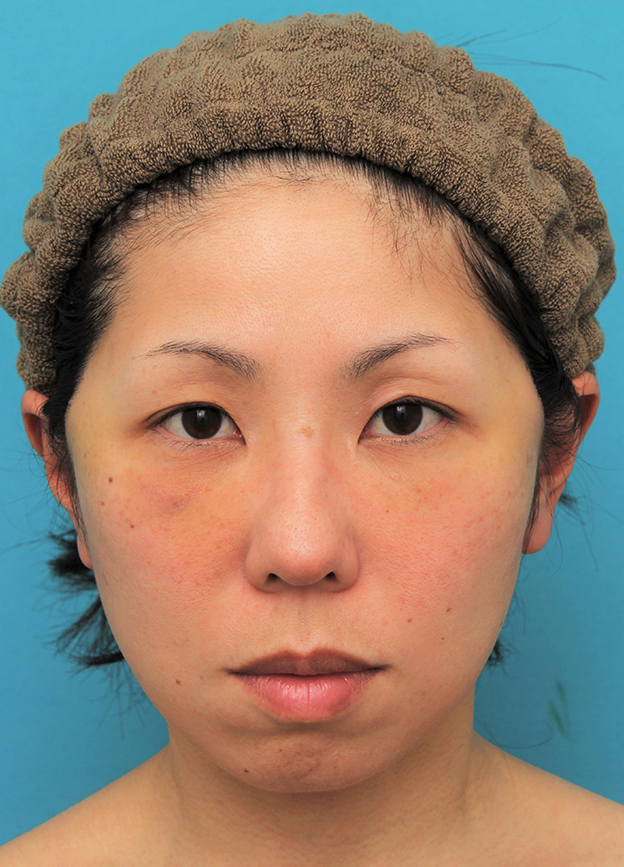 ミディアムフェイスリフト,ミディアムフェイスリフトの症例 頬～フェイスラインのたるみが目立つ40代女性,6日後,mainpic_mediumlift015c.jpg