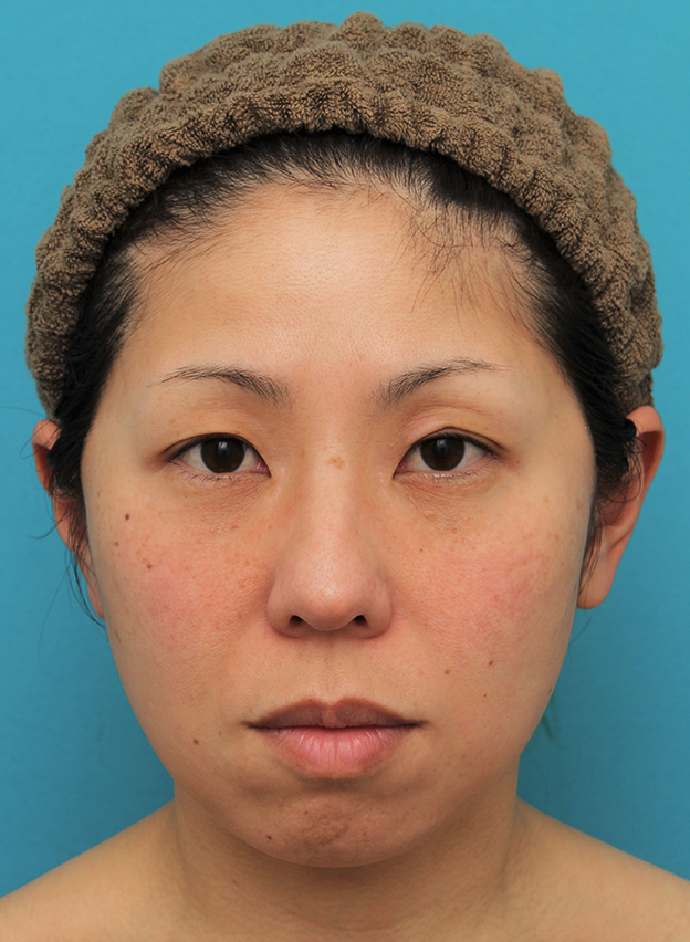 ミディアムフェイスリフト,ミディアムフェイスリフトの症例 頬～フェイスラインのたるみが目立つ40代女性,3週間後,mainpic_mediumlift015d.jpg