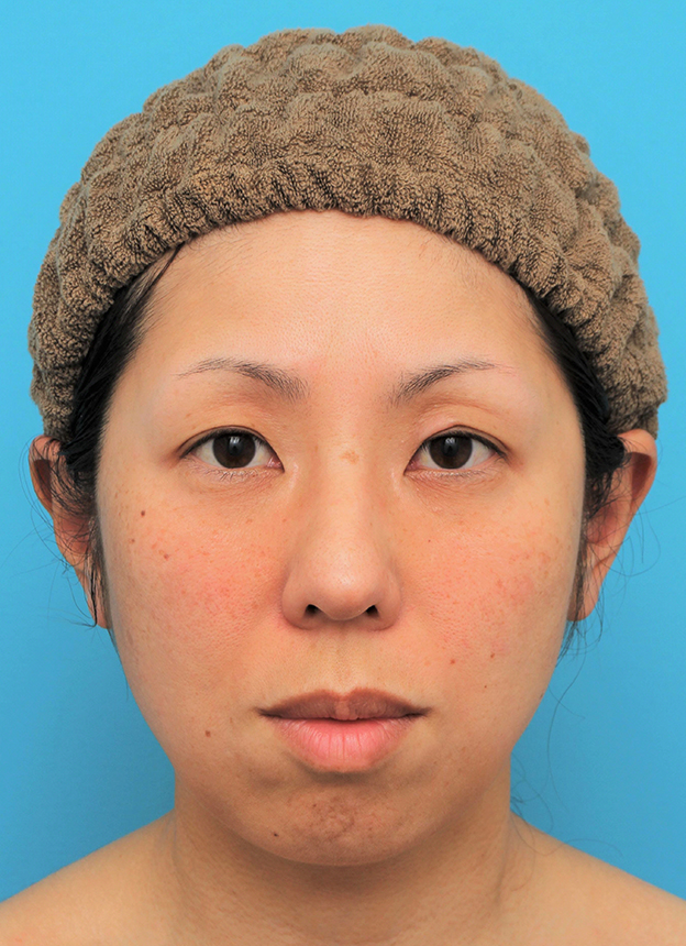 ミディアムフェイスリフト,ミディアムフェイスリフトの症例 頬～フェイスラインのたるみが目立つ40代女性,6ヶ月後,mainpic_mediumlift015e.jpg