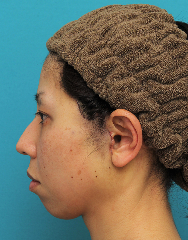 ミディアムフェイスリフト,ミディアムフェイスリフトの症例 頬～フェイスラインのたるみが目立つ40代女性,手術直後,mainpic_mediumlift015g.jpg
