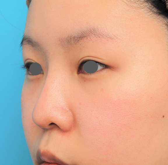 鼻翼縮小（小鼻縮小）,鼻シリコンプロテーゼ+鼻先耳介軟骨移植+小鼻縮小の症例写真,After（6ヶ月後）,ba_ryubi80_b02.jpg