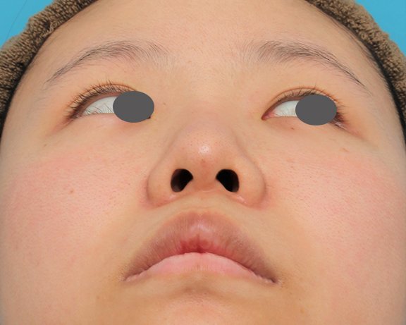 鼻翼縮小（小鼻縮小）,鼻シリコンプロテーゼ+鼻先耳介軟骨移植+小鼻縮小の症例写真,After（6ヶ月後）,ba_ryubi80_b04.jpg