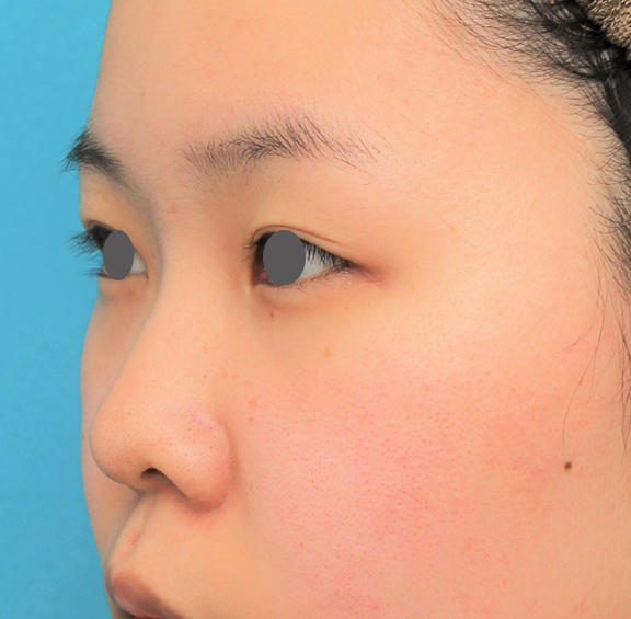 鼻翼縮小（小鼻縮小）,鼻シリコンプロテーゼ+鼻先耳介軟骨移植+小鼻縮小の症例写真,Before,ba_ryubi80_b02.jpg
