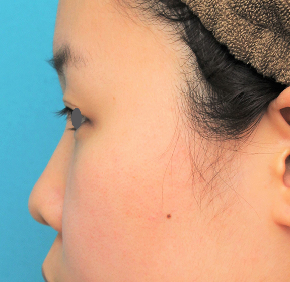 鼻翼縮小（小鼻縮小）,鼻シリコンプロテーゼ+鼻先耳介軟骨移植+小鼻縮小の症例写真,Before,ba_ryubi80_b03.jpg