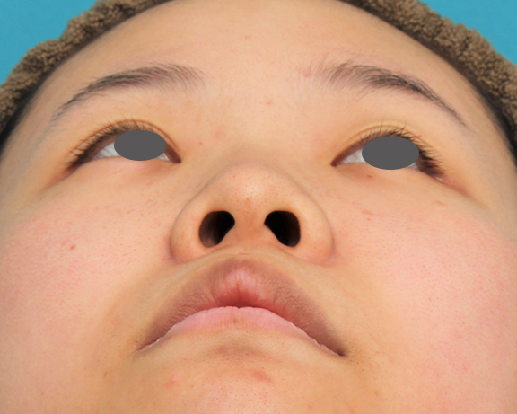 鼻翼縮小（小鼻縮小）,鼻シリコンプロテーゼ+鼻先耳介軟骨移植+小鼻縮小の症例写真,Before,ba_ryubi80_b04.jpg