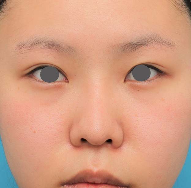 鼻翼縮小（小鼻縮小）,鼻シリコンプロテーゼ+鼻先耳介軟骨移植+小鼻縮小の症例写真,6ヶ月後,mainpic_ryubi80f.jpg