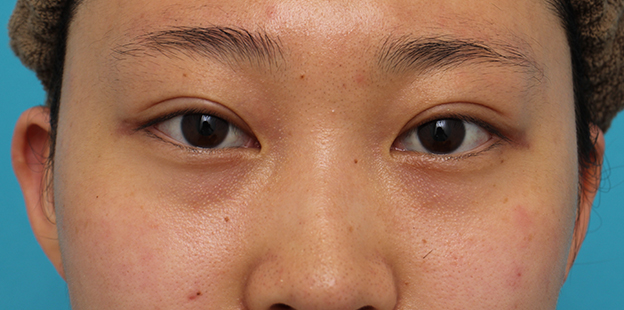症例写真,二重まぶた・全切開法の症例 術後6ヶ月経過のモニター患者様,1ヶ月後,目を開けた状態,mainpic_sekkai073d.jpg