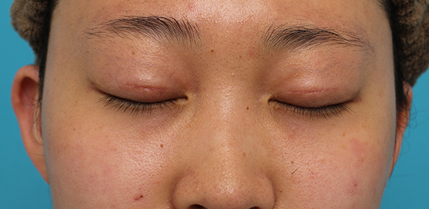 症例写真,二重まぶた・全切開法の症例 術後6ヶ月経過のモニター患者様,1ヶ月後,目を閉じた状態,mainpic_sekkai073e.jpg