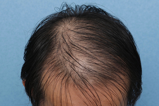 AGA治療（高須式メディカル育毛プログラム）,男性の育毛治療の症例写真,治療前,mainpic_aga030a.jpg