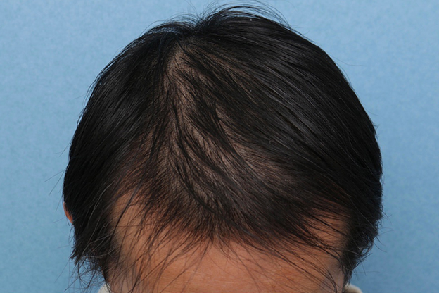 AGA治療（高須式メディカル育毛プログラム）,男性の育毛治療の症例写真,4ヶ月後,mainpic_aga030b.jpg