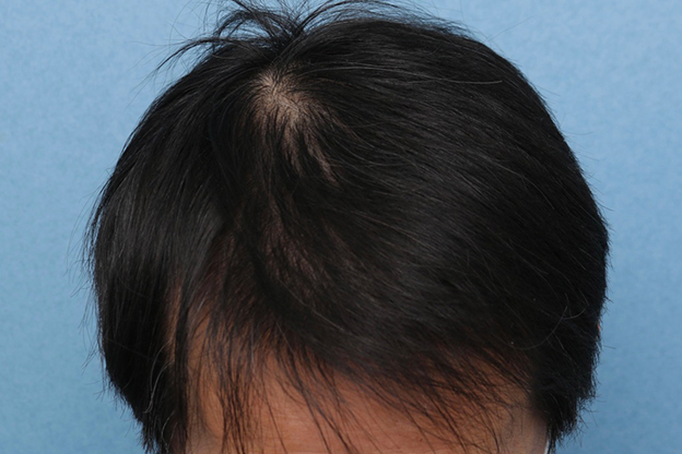 AGA治療（高須式メディカル育毛プログラム）,男性の育毛治療の症例写真,6ヶ月後,mainpic_aga030c.jpg