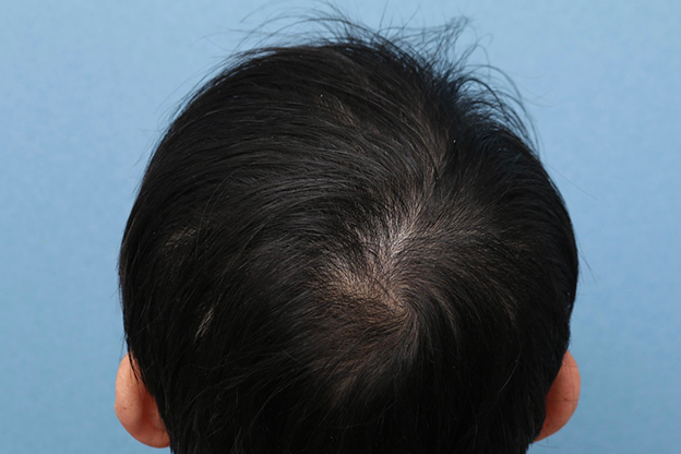 AGA治療（高須式メディカル育毛プログラム）,男性の育毛治療の症例写真,4ヶ月後,mainpic_aga030e.jpg