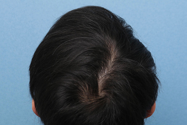 AGA治療（高須式メディカル育毛プログラム）,男性の育毛治療の症例写真,6ヶ月後,mainpic_aga030f.jpg