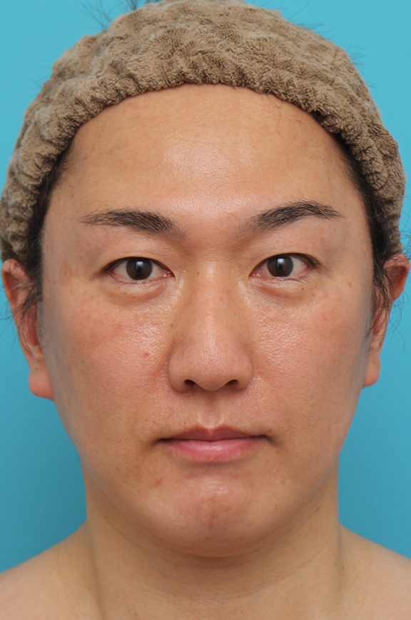 鼻翼縮小（小鼻縮小）,鼻翼縮小の症例写真,After（6ヶ月後）,ba_biyoku051_a01.jpg