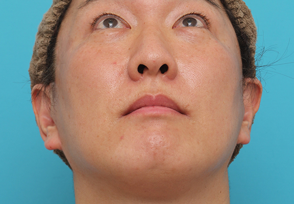 鼻翼縮小（小鼻縮小）,鼻翼縮小の症例写真,After（6ヶ月後）,ba_biyoku051_b02.jpg