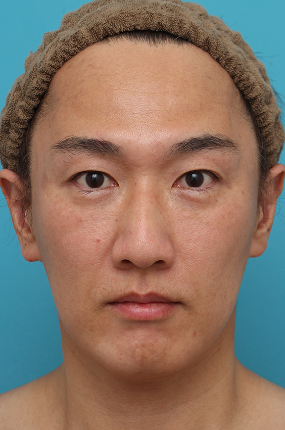 鼻翼縮小（小鼻縮小）,鼻翼縮小の症例写真,Before,ba_biyoku051_b01.jpg