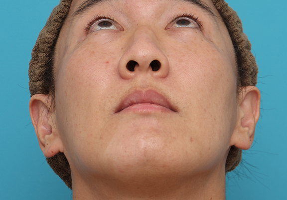 鼻翼縮小（小鼻縮小）,鼻翼縮小の症例写真,Before,ba_biyoku051_b02.jpg