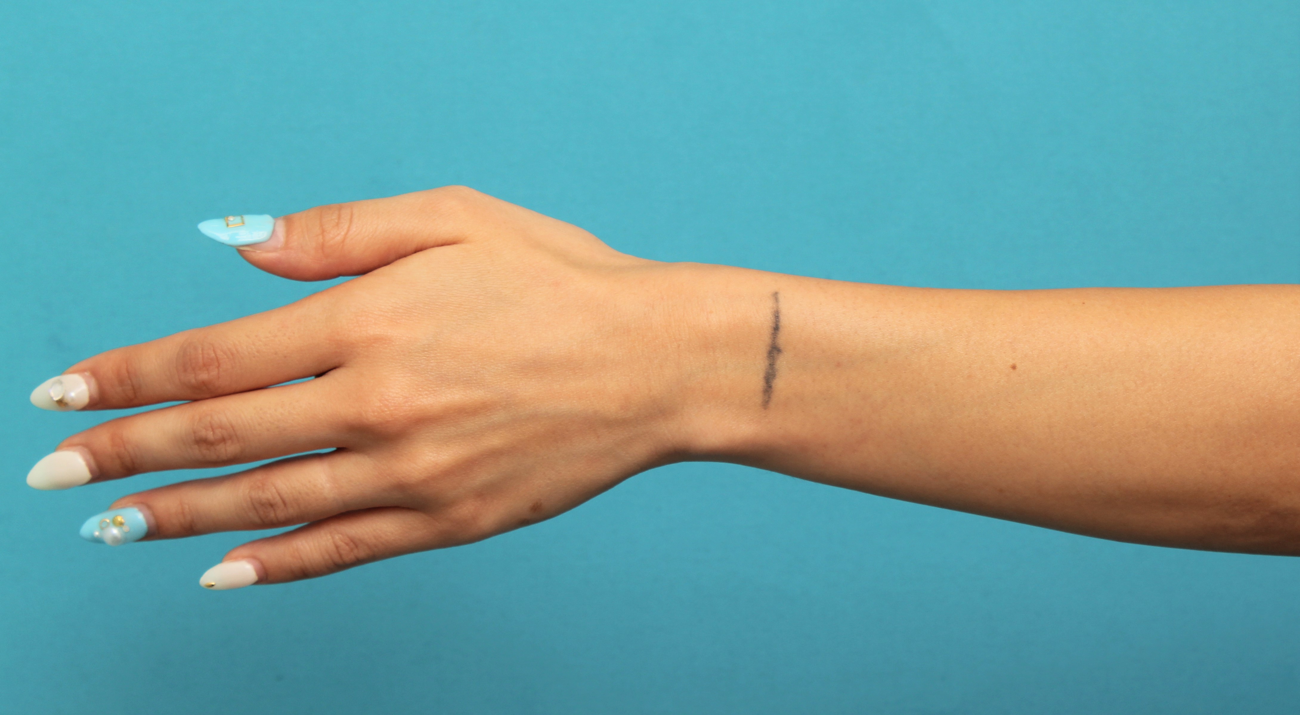 刺青（タトゥー）除去,墨汁の入れ墨をレーザー治療した症例写真,Before,ba_irezumi036_b01.jpg