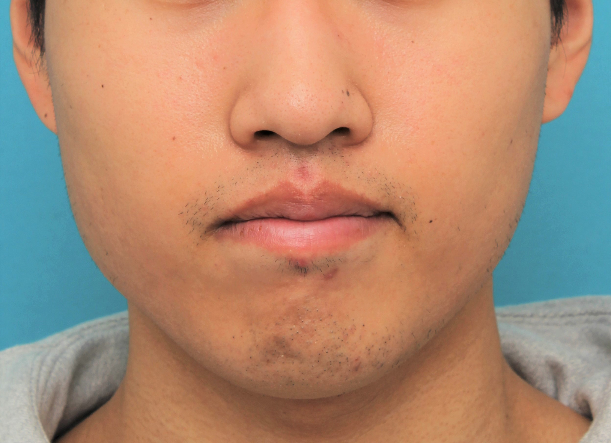 手術で上下の唇を薄くした20代男性の症例写真,After（4ヶ月後）,ba_usuku017_a01.jpg