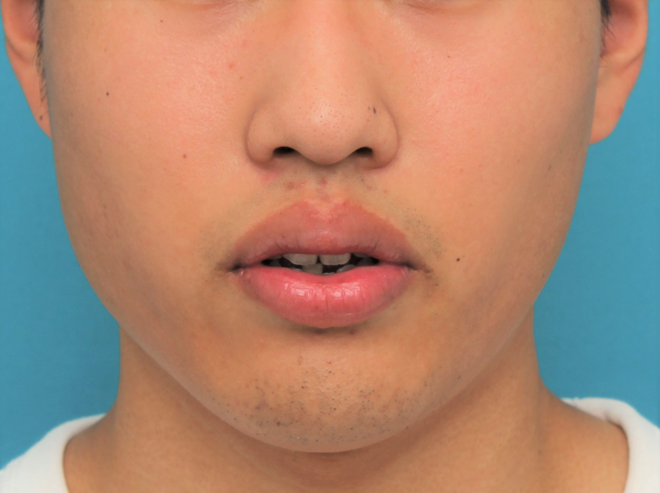 唇を薄く（口唇縮小術）,手術で上下の唇を薄くした20代男性の症例写真,Before,ba_usuku017_b02.jpg
