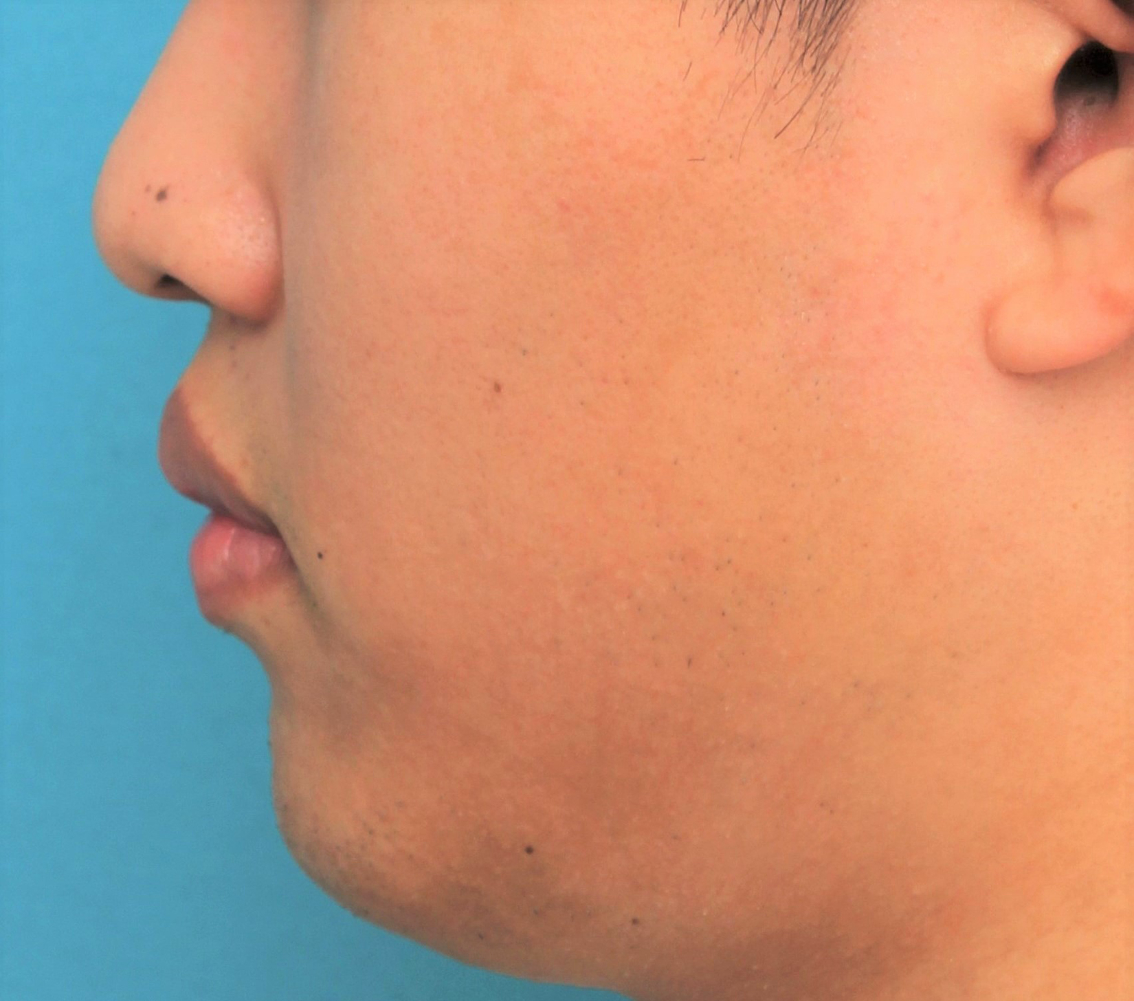 唇を薄く（口唇縮小術）,手術で上下の唇を薄くした20代男性の症例写真,Before,ba_usuku017_b03.jpg