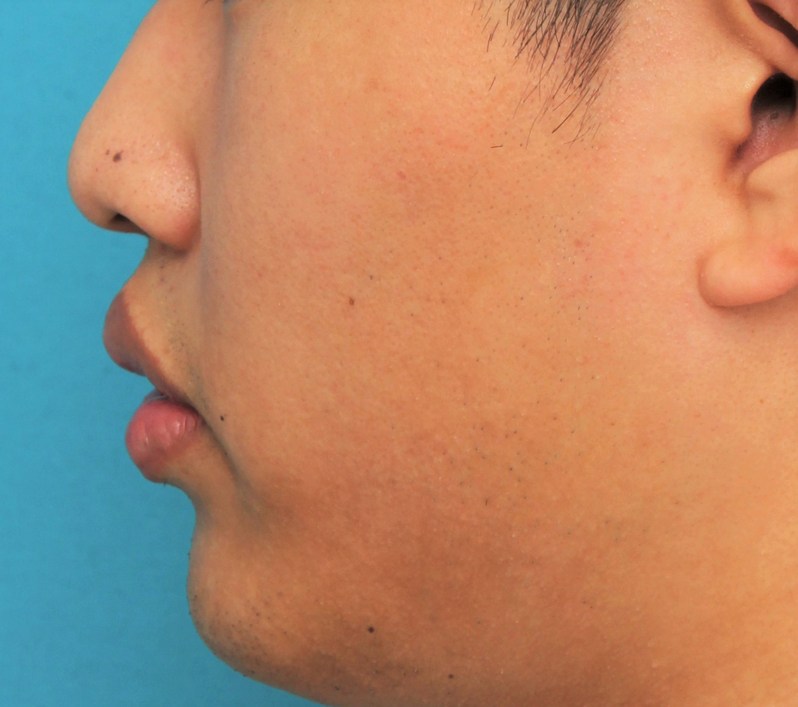 唇を薄く（口唇縮小術）,手術で上下の唇を薄くした20代男性の症例写真,Before,ba_usuku017_b04.jpg