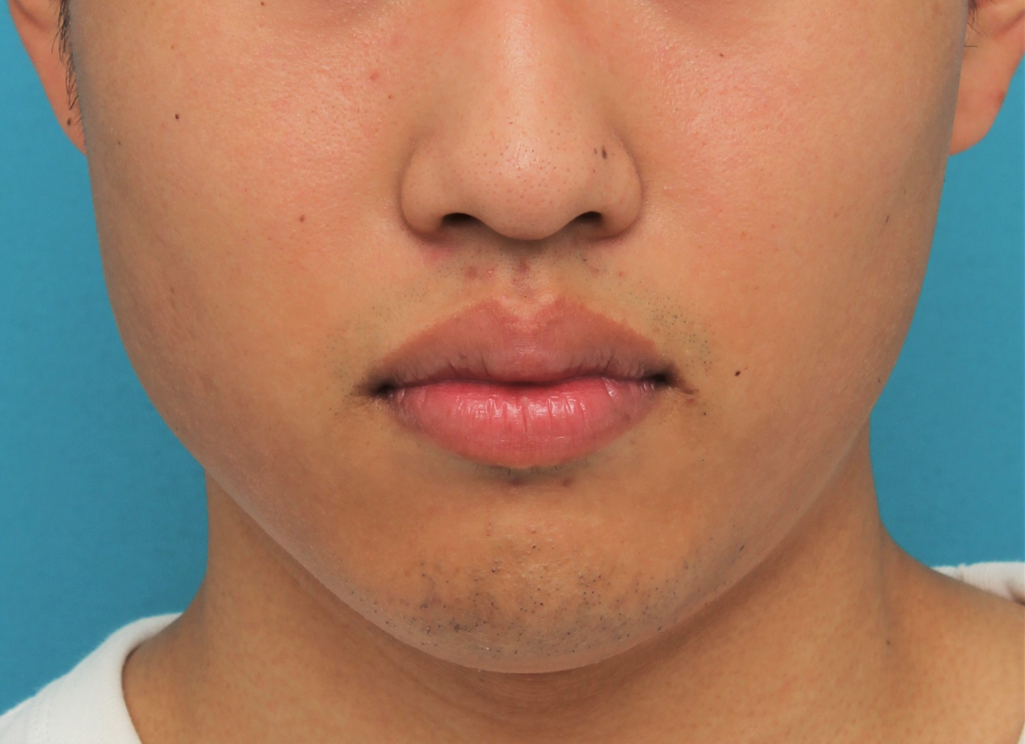 唇を薄く（口唇縮小術）,手術で上下の唇を薄くした20代男性の症例写真,手術前,口を閉じた状態,mainpic_usuku017a.jpg