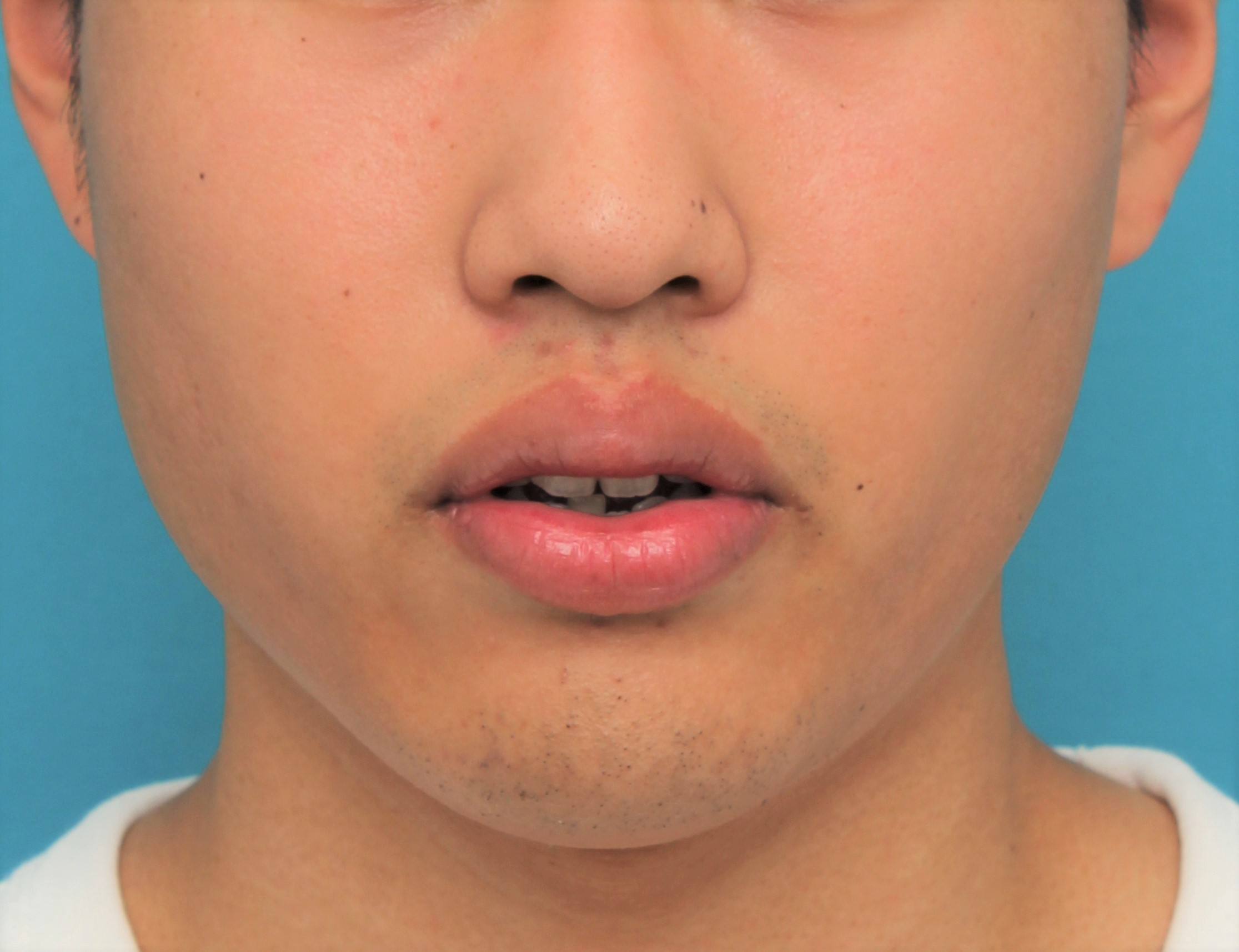 唇を薄く（口唇縮小術）,手術で上下の唇を薄くした20代男性の症例写真,手術前,口を半開きにした状態,mainpic_usuku017b.jpg
