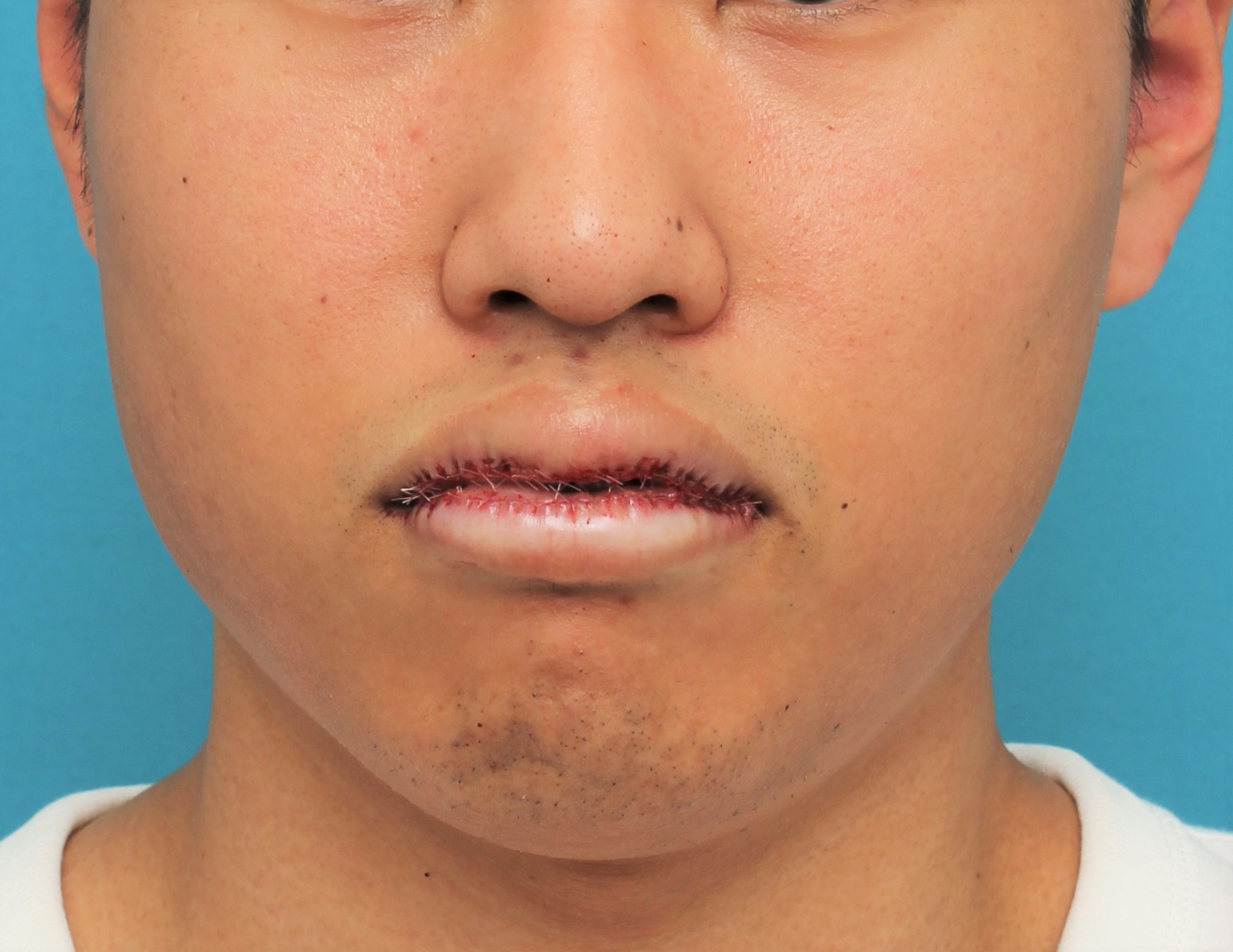 唇を薄く（口唇縮小術）,手術で上下の唇を薄くした20代男性の症例写真,手術直後,mainpic_usuku017c.jpg
