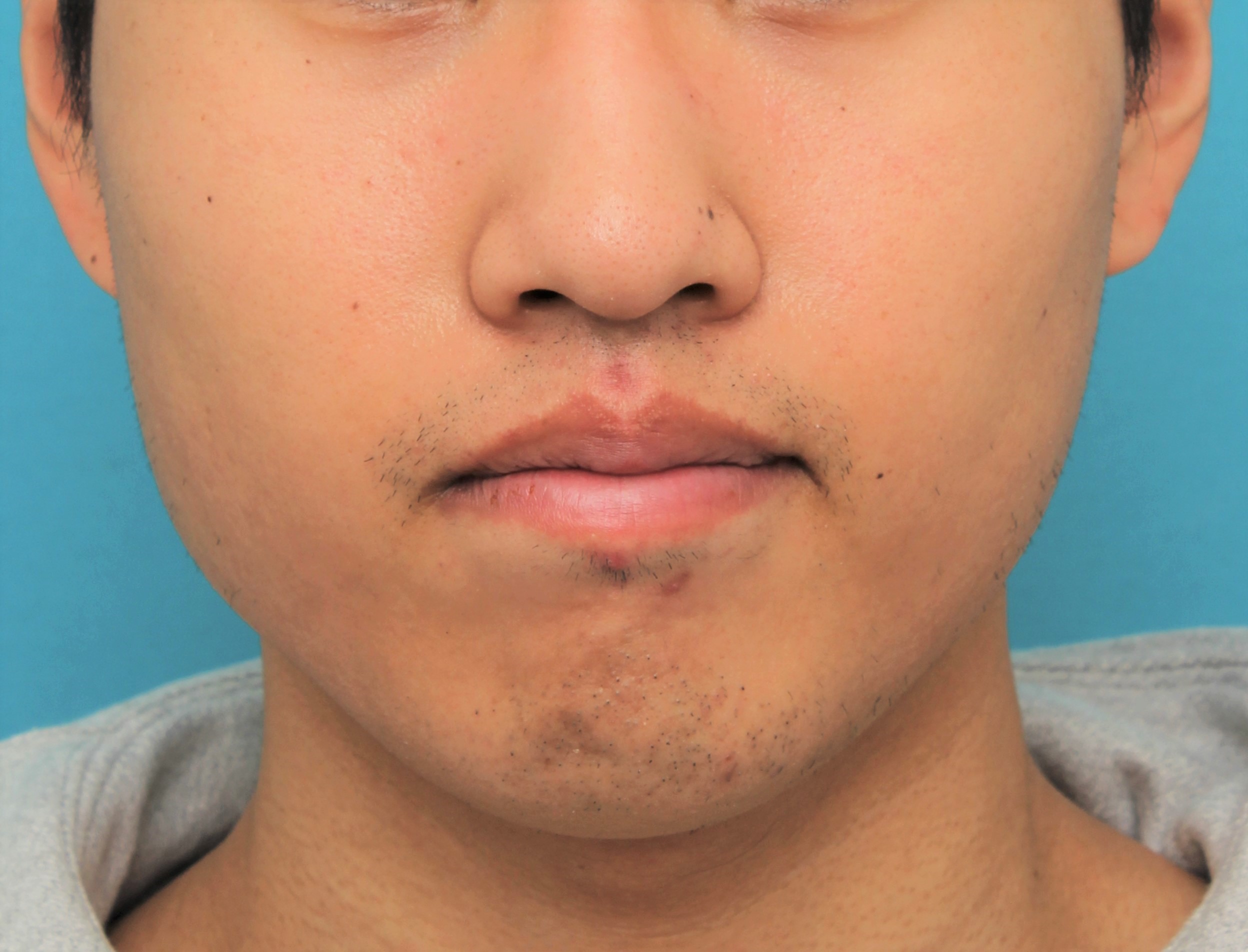 唇を薄く（口唇縮小術）,手術で上下の唇を薄くした20代男性の症例写真,4ヶ月後,口を閉じた状態,mainpic_usuku017f.jpg