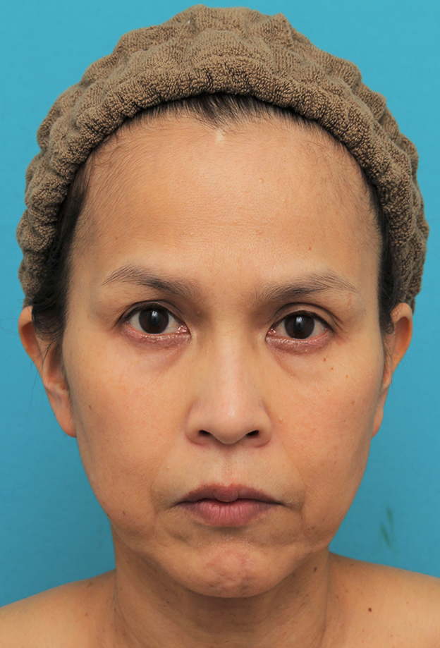 ミディアムフェイスリフト,ミディアムフェイスリフトを行った50代女性の症例写真,手術前,mainpic_mediumlift016a.jpg