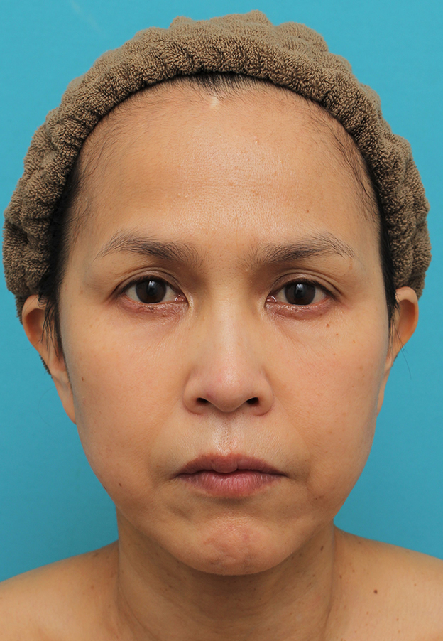 症例写真,ミディアムフェイスリフトを行った50代女性の症例写真,2ヶ月後,mainpic_mediumlift016e.jpg