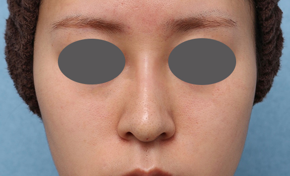 隆鼻注射（ヒアルロン酸注射）,鼻筋ヒアルロン酸注射の症例写真,After,ba_ryubi2039_a01.jpg