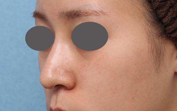 隆鼻注射（ヒアルロン酸注射）,鼻筋ヒアルロン酸注射の症例写真,After,ba_ryubi2039_b02.jpg