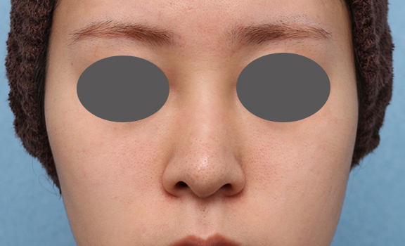 隆鼻注射（ヒアルロン酸注射）,鼻筋ヒアルロン酸注射の症例写真,Before,ba_ryubi2039_b01.jpg