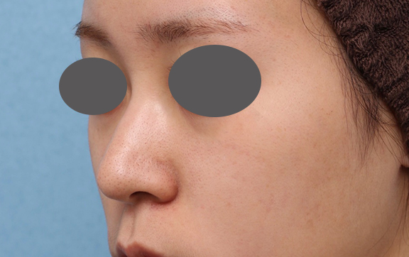 隆鼻注射（ヒアルロン酸注射）,鼻筋ヒアルロン酸注射の症例写真,Before,ba_ryubi2039_b02.jpg