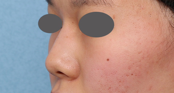 症例写真,隆鼻注射（ヒアルロン酸注射）の症例 高くなりすぎずナチュラルな鼻筋をご希望,After,ba_ryubi2040_b02.jpg
