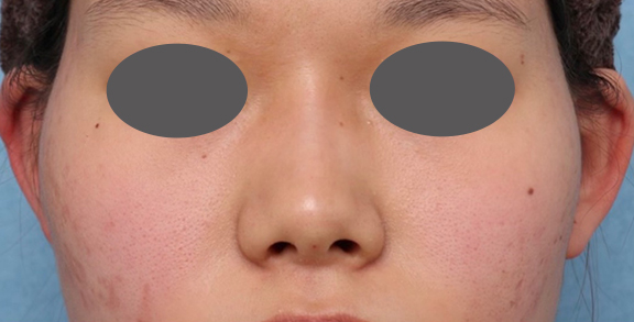 症例写真,隆鼻注射（ヒアルロン酸注射）の症例 高くなりすぎずナチュラルな鼻筋をご希望,After,ba_ryubi2040_b03.jpg