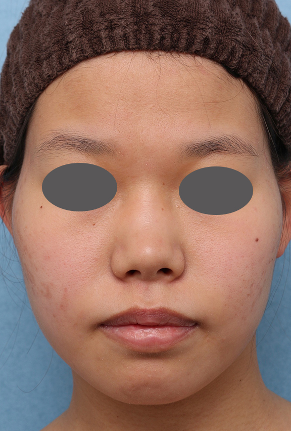 症例写真,隆鼻注射（ヒアルロン酸注射）の症例 高くなりすぎずナチュラルな鼻筋をご希望,Before,ba_ryubi2040_b01.jpg