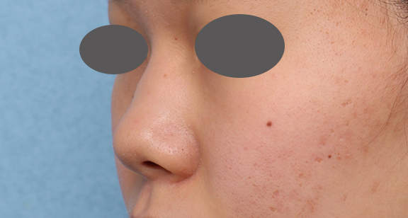 症例写真,隆鼻注射（ヒアルロン酸注射）の症例 高くなりすぎずナチュラルな鼻筋をご希望,Before,ba_ryubi2040_b02.jpg