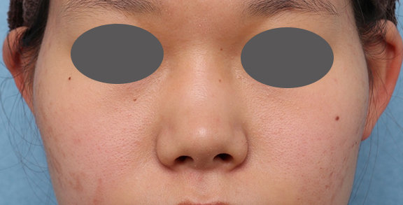 隆鼻注射（ヒアルロン酸注射）,隆鼻注射（ヒアルロン酸注射）の症例 高くなりすぎずナチュラルな鼻筋をご希望,Before,ba_ryubi2040_b03.jpg