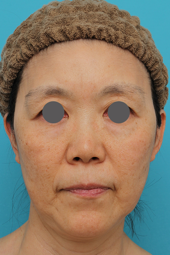 ミニフェイスリフト（頬のたるみ取り）,ミニフェイスリフトの症例 フェイスラインのたるみがかなり改善された女性,Before,ba_minilift010_b01.jpg