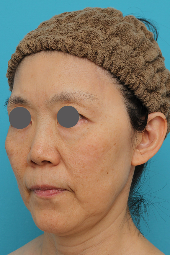 ミニフェイスリフト（頬のたるみ取り）,ミニフェイスリフトの症例 フェイスラインのたるみがかなり改善された女性,Before,ba_minilift010_b02.jpg
